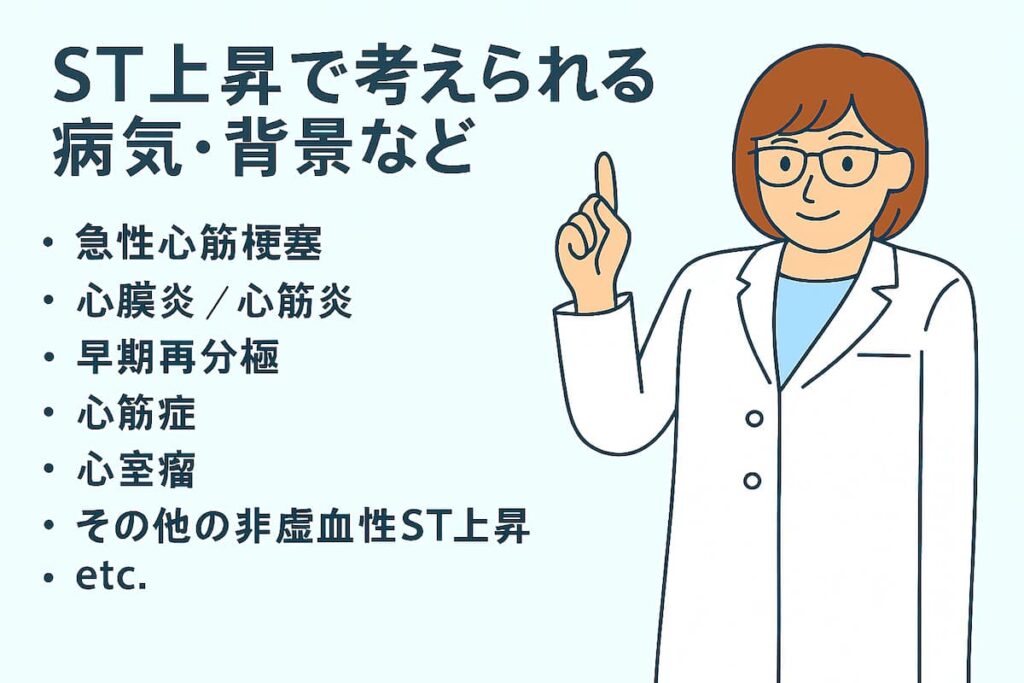 心電図波形、ST上昇で考えられる病気や背景を医師が説明しています。